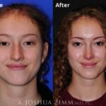 Rhinoplasty 2019 Front Smile 194