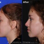 Rhinoplasty 2019 Left 190