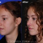 Rhinoplasty 2019 Left Oblique 189