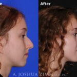 Rhinoplasty 2019 Right 192
