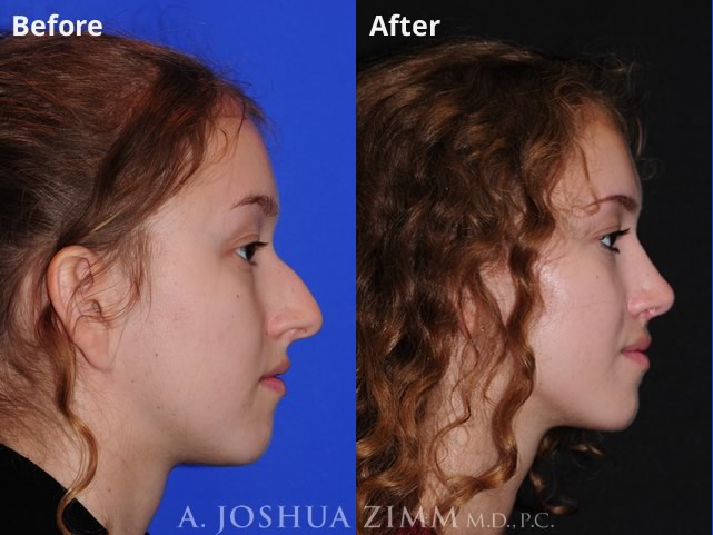 Rhinoplasty 2019 Right 192