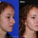 Rhinoplasty 2019 Right Oblique 191