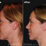 Rhinoplasty 2020 Left 3