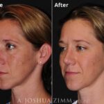 Rhinoplasty 2020 Oblique Left 3