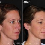 Rhinoplasty 2020 Oblique Right 3