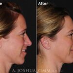 Rhinoplasty 2020 Right 3