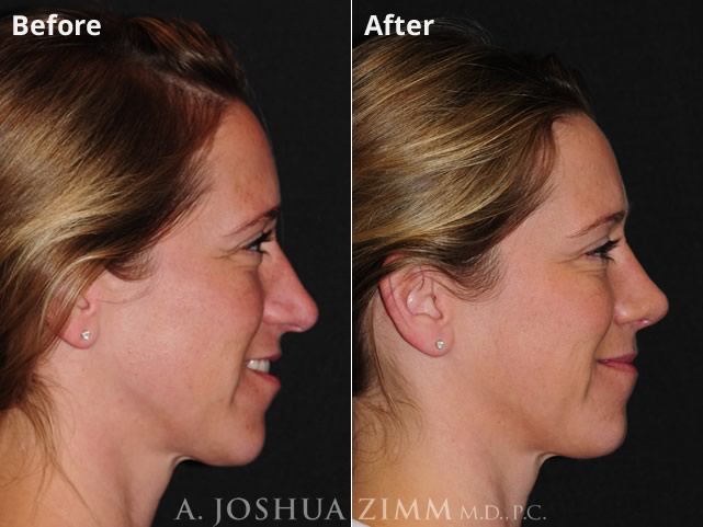 Rhinoplasty 2020 Right 3