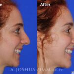 Rhinoplasty2016101