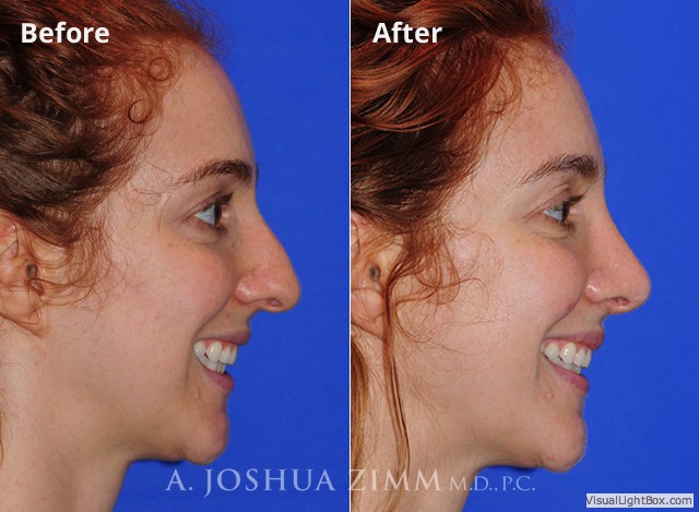 Rhinoplasty2016101