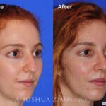Rhinoplasty2016102