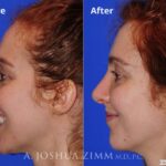 Rhinoplasty2016103