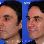 Rhinoplasty2016107