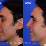 Rhinoplasty2016108