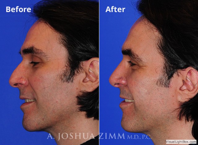 Rhinoplasty2016108
