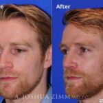 Rhinoplasty2016109