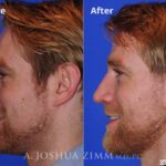 Rhinoplasty2016110
