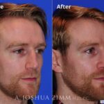 Rhinoplasty2016111