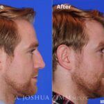 Rhinoplasty2016112