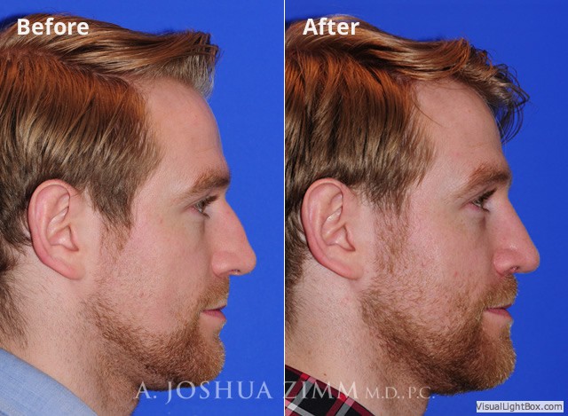 Rhinoplasty2016112