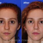 Rhinoplasty2016115