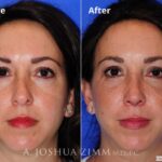 Rhinoplasty2016116