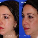 Rhinoplasty2016117