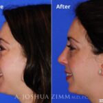 Rhinoplasty2016118