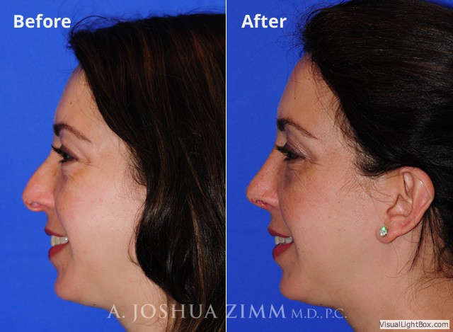 Rhinoplasty2016118