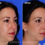 Rhinoplasty2016119