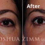 Rhinoplasty2016120 1