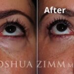 Rhinoplasty2016121 1