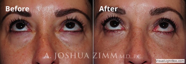Rhinoplasty2016121 1
