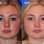 Rhinoplasty2016122