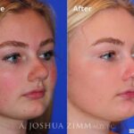 Rhinoplasty2016123
