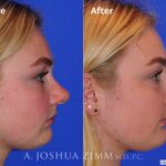 Rhinoplasty2016124