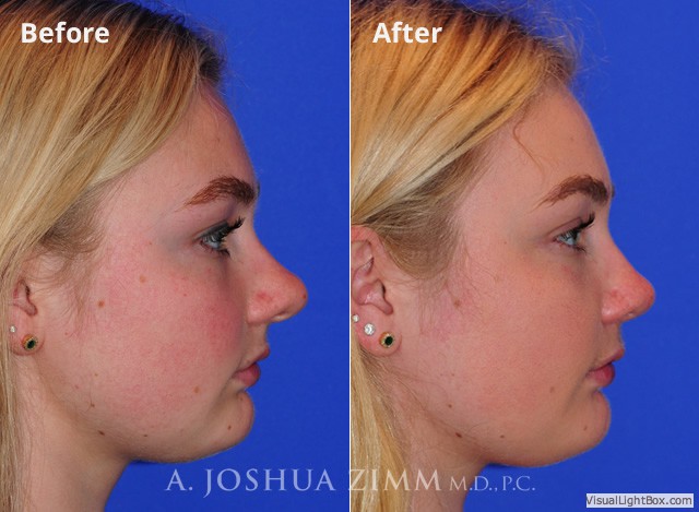 Rhinoplasty2016124
