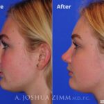 Rhinoplasty2016125