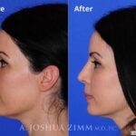 Rhinoplasty2016136
