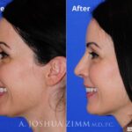 Rhinoplasty2016137