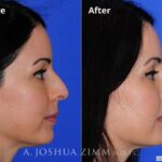 Rhinoplasty2016138