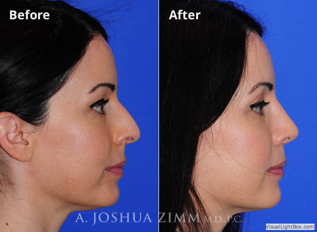 Rhinoplasty2016138