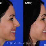 Rhinoplasty2016139