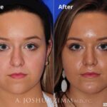 Rhinoplasty2016140