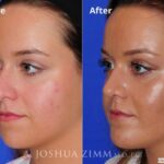 Rhinoplasty2016141