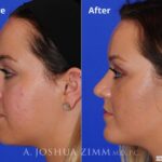 Rhinoplasty2016142