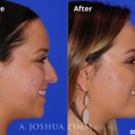 Rhinoplasty2016143