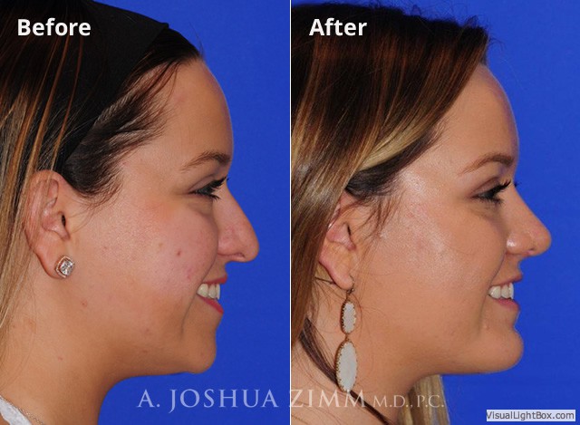 Rhinoplasty2016143
