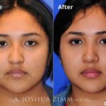 Rhinoplasty201616