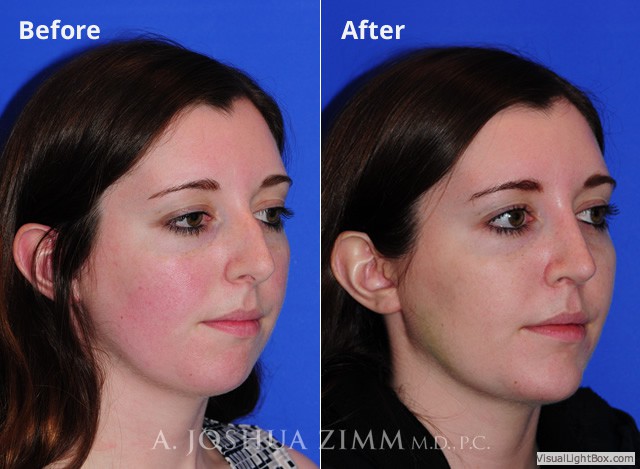 Rhinoplasty2016163 1