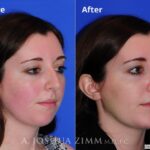 Rhinoplasty2016163